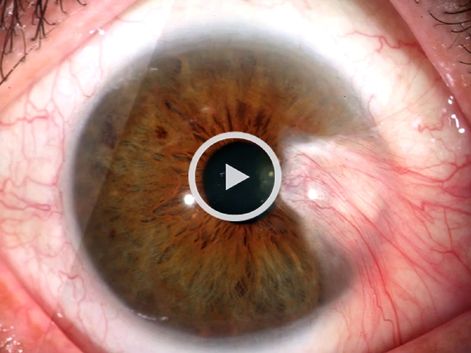 Dr. Sauvageot talks about pterygium