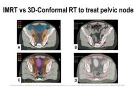 IMRT vs 3D-Conformal RT to treat pelvic ganglia in prostate cancer