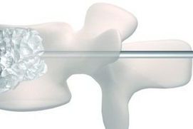 Vertebroplasty is a solution to back pain