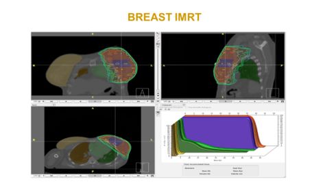 Reducción de las estenosis coronarias gracias al empleo de IMRT en Cáncer de Mama