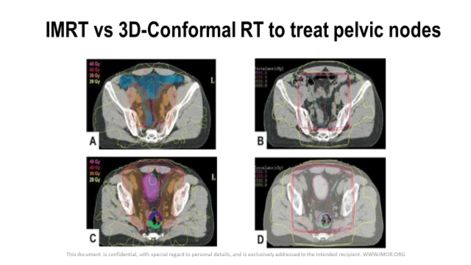 IMRT vs RT 3D Conformada para tratar los ganglios pélvicos en cáncer de próstata