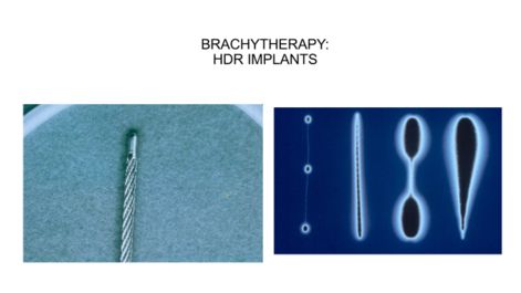Braquiterapia de próstata: implantes hdr