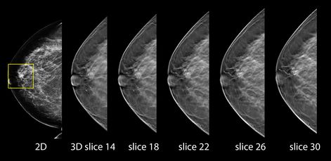 3D mammography